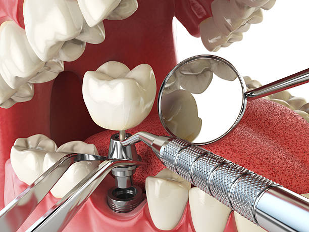 Best Emergency Tooth Extraction in Indian Wells, CA